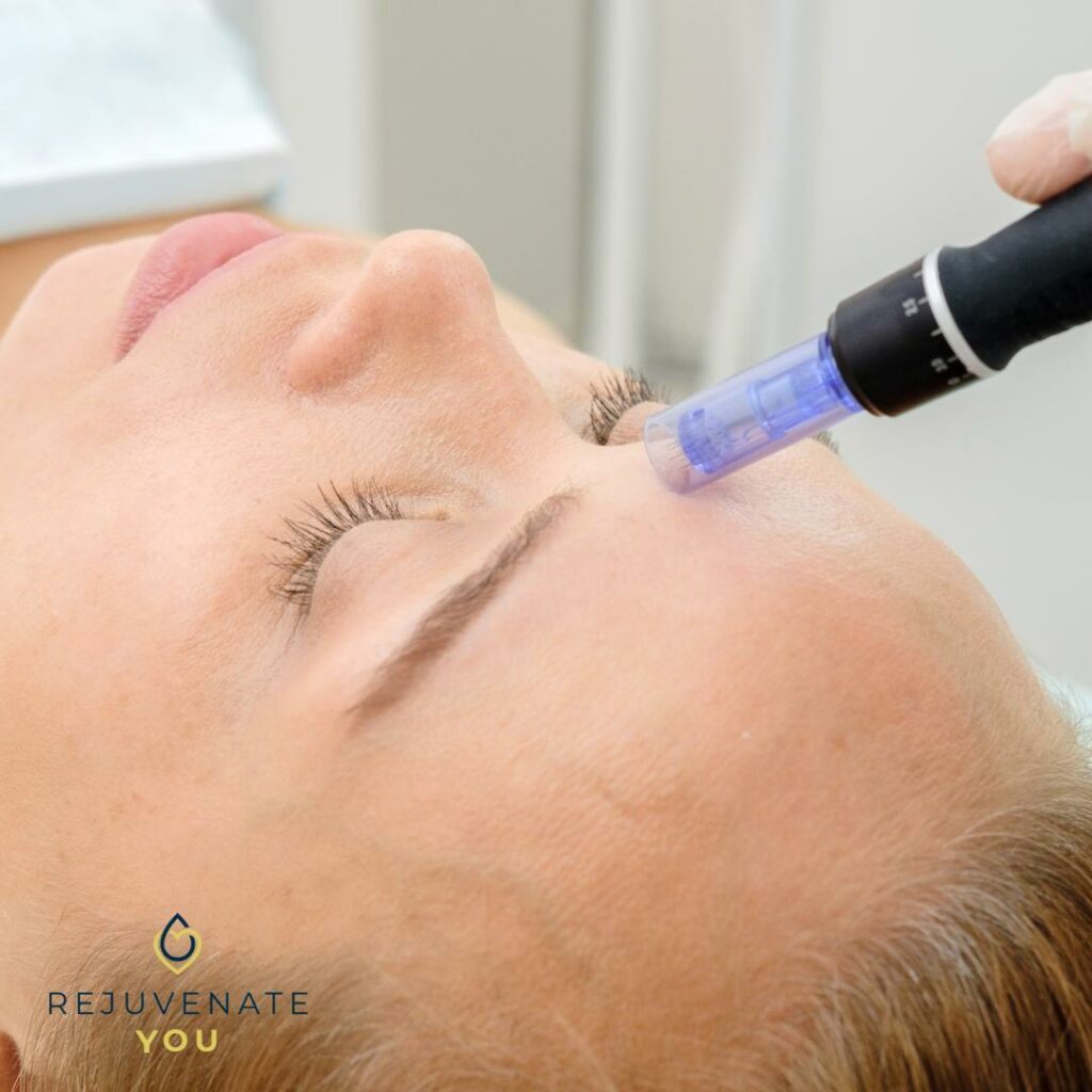 A woman receiving a facial microneedling treatment at Rejuvenate You.