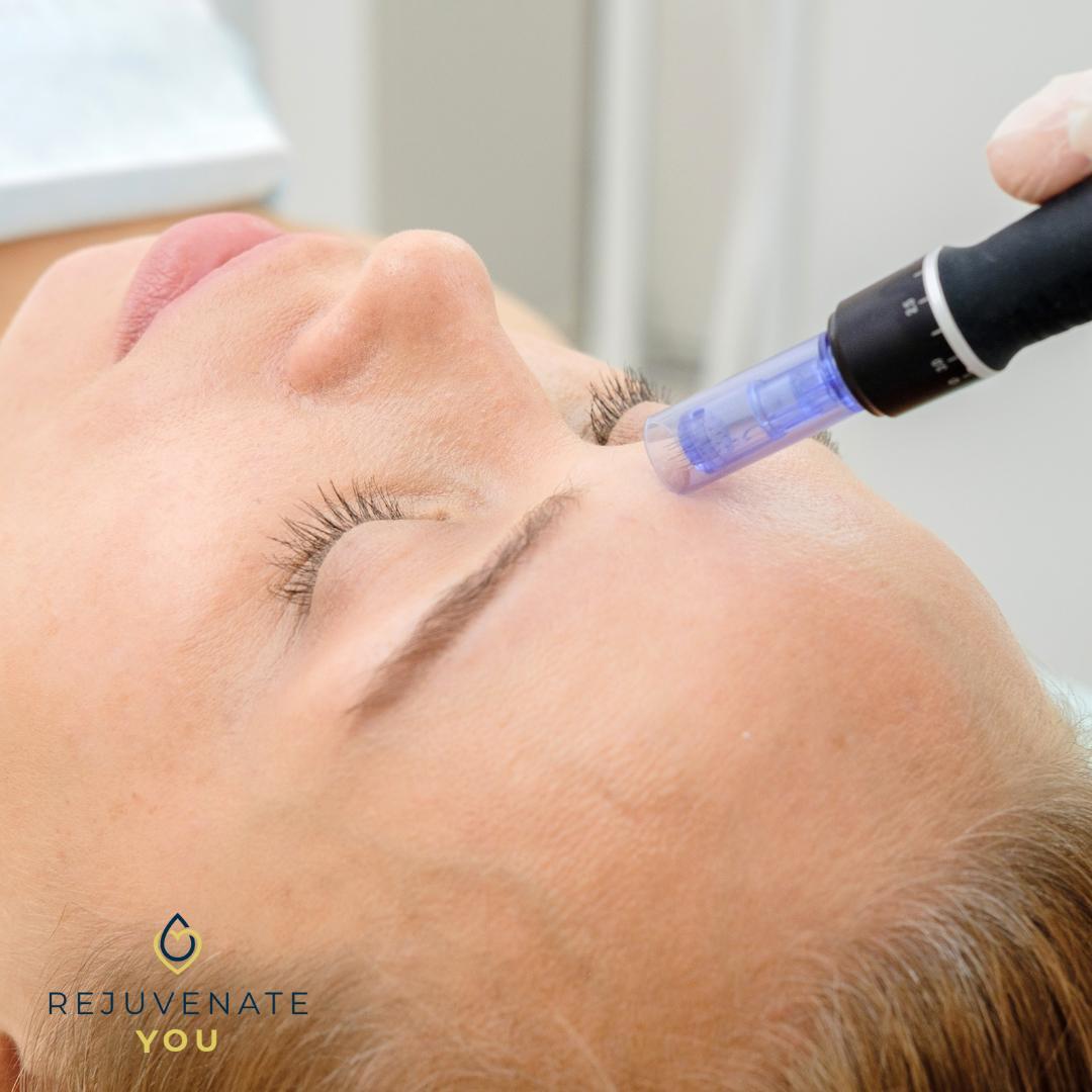 A woman receiving microneedling treatment at Rejuvenate You.