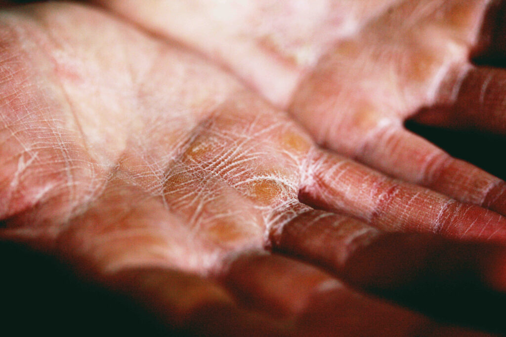 Dry skin on a pair of hands, a sign of dehydration in adults.